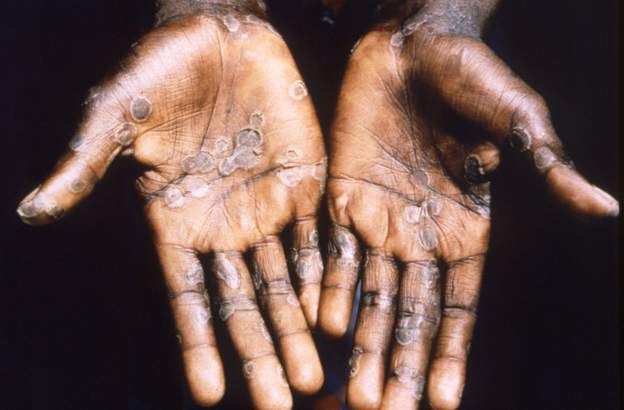 Ghana records 84 cases of Monkeypox with 4 deaths     